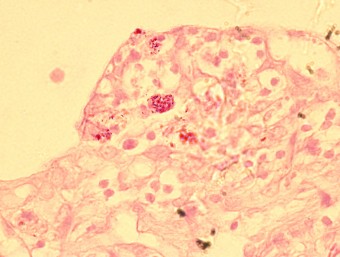 M. paratuberculosis, cow, ZN staining