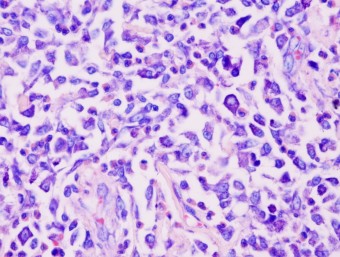 mast cell tumor, 2-3 gr., low numbers of granules, Giemsa 