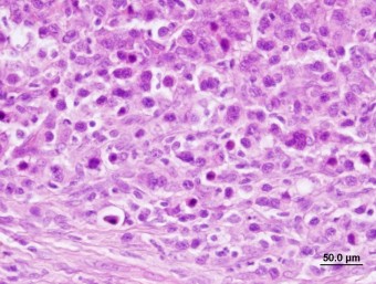 plasma cell tumor,detail